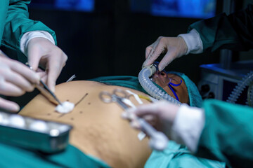 A team of professional doctors perform surgery in a hospital, a group of surgeons working in the operating theater.