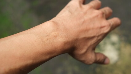 stitches on Male's wrist