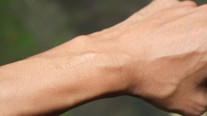 stitches on a boy's wrist