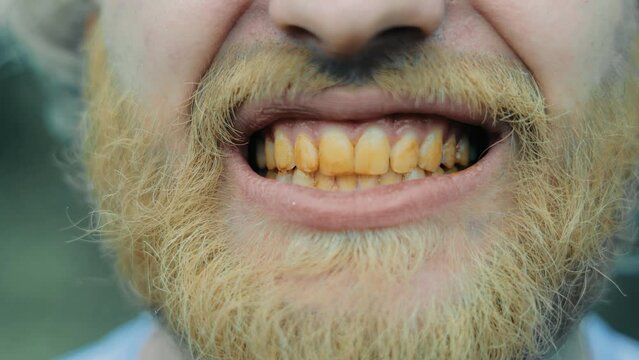 The smile of a homeless person or a dirty unkempt person. Close-up of dirty teeth and yellow beard