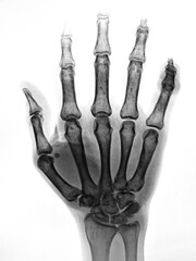Photo of x-ray human hand.