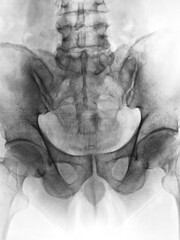 Film x-ray pelvis of patient 