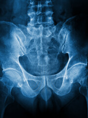 X-ray of the pelvis 