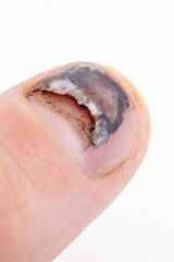 Obraz premium Nail peels off on finger and bruise