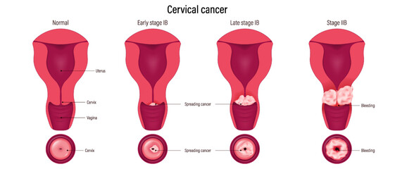 Cervical cancer development. cervix carcinoma stages. Female reproductive system disease.