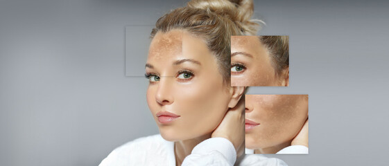 Dark spots, freckles,hyperpigmentation(melasma or chloasma),concept - skin lightening, skin...
