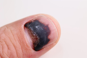 Palec człowieka z czarnym paznokciem - krwiak pod paznokciem.  - obrazy, fototapety, plakaty