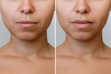 Result of lip augmentation. Cropped shot of young woman's lower part of face with lips before and...