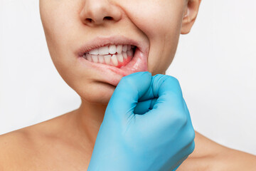 Gum inflammation. Young woman's face with doctor's hand in a blue glove on the jaw showing red...