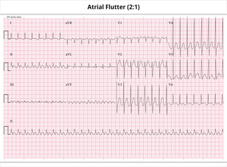 ECG Atrial Flutter (2:1) - ECG Paper 12 Lead