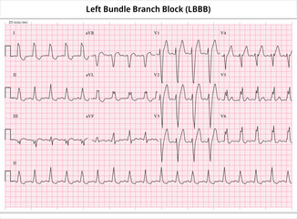 ECG Left Bundle Branch Block - ECG Paper 12 Lead