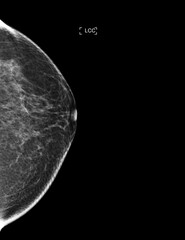 X-ray Digital Mammogram or mammography of both side breast showing benign tumor BI-RADS 2 should be checked once a year.