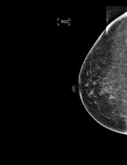 X-ray Digital Mammogram or mammography of both side breast showing Normal breast BI-RADS 1 should be checked once a year.