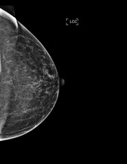 X-ray Digital Mammogram or mammography of both side breast showing Normal breast BI-RADS 1 should be checked once a year.