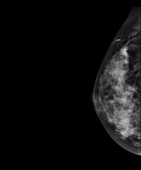 X-ray Digital Mammogram or mammography of both side breast showing benign tumor BI-RADS 2 should be checked once a year.