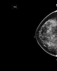 X-ray Digital Mammogram or mammography of both side breast showing benign tumor BI-RADS 3 should be...