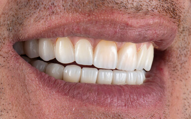emax crowns on hybrid bridge on implants