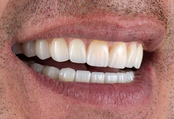 Obraz premium emax crowns on hybrid bridge on implants