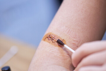 surgical suture wound on the arm treatment of the wound with iodine