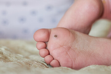 Close-up of a wart on a child's foot, a new wart is visible on the big toe.. - obrazy, fototapety, plakaty