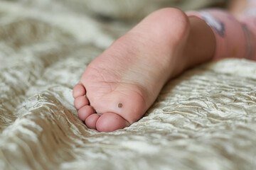Close-up of a wart on a child's foot, a new wart is visible on the big toe..