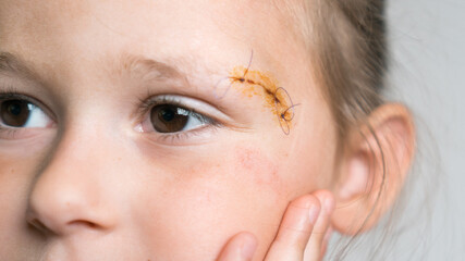 Close up sad, drear cropped cute girl face with stitches on scratch of eyebrow dissection, looking...