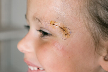 Close up smiling patient kid girl face with stitches, joints on scratch of eyebrow dissection...