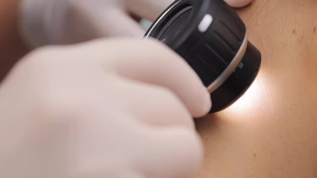 Dermatologist examining mole with magnifying glass in clinic