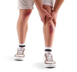 Man with bruises on legs against white background