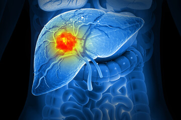 Liver cancer, Hepatocellular Carcinoma (HCC), conditions, causes and treatment. 3d illustration - obrazy, fototapety, plakaty