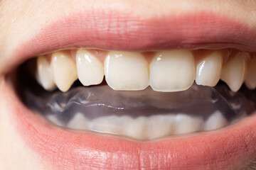 Dental mouthguard, splint in the mouth for the treatment of dysfunction of the temporomandibular joints, bruxism, malocclusion, to relax the muscles of the jaw.