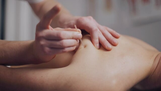 Acupuncture. In the spa, the masseur does acupuncture on the client's back.