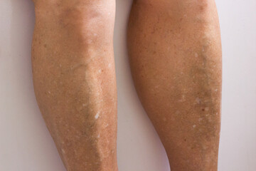 Freckled legs, white spots from age or sun exposure leucoderma. Sun spots, Senile lentigo, Solar...