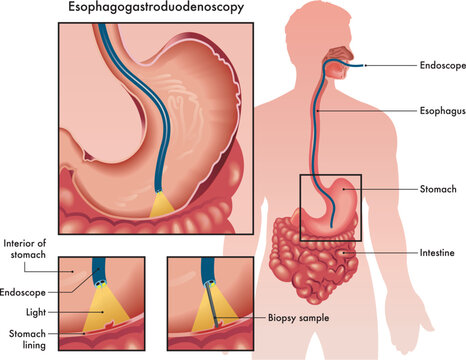 Medical illustration of an Esophagogastroduodenoscopy with two details showing the procedure and instruments used, with annotations.