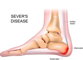 Severs disease. calcaneus apophysitis. inflammation at the back of the heel growth plate.