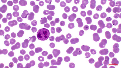 Light micrograph showing human blood cells. Erythrocytes are pink. They make up the majority of blood cells. Also in the center you can see a large cell with a nucleus (neutrophil).	