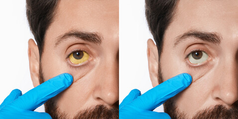 Collage with photos of man before and after hepatitis treatment. Doctor checking patient on white background, closeup