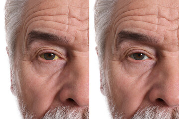 Collage with photos of senior man before and after hepatitis treatment, focus on eyes