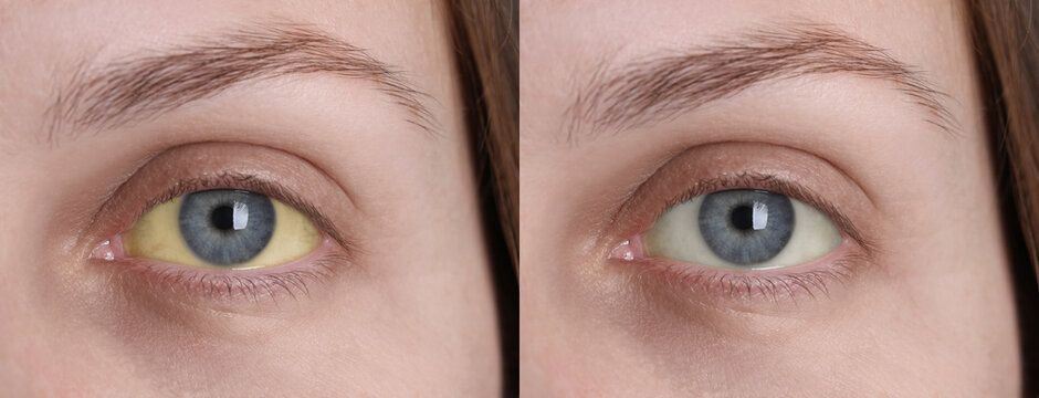 Collage with photos of woman before and after hepatitis treatment, focus on eyes. Banner design