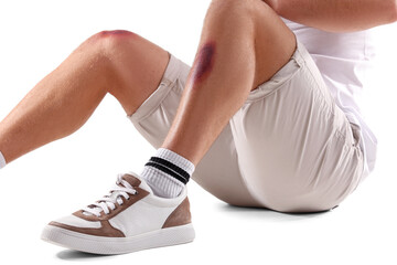 Man with bruise on leg against white background