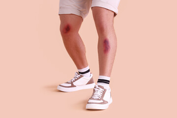 Man with bruises on legs against beige background