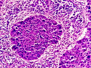 Photomicrograph showing tongue squamous cell carcinoma Grade II. Oral Invasive SCC.