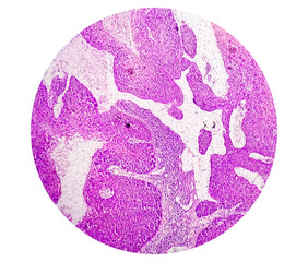 Photomicrograph showing tongue squamous cell carcinoma Grade II. Oral Invasive SCC.