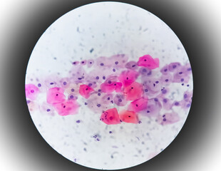 Paps smear under microscopy showing inflammatory smear with hpv related changes. Cervical cancer....