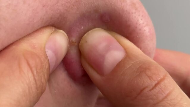 Cropped shot of teenager squeezing red inflamed pimple on nose, acne problems, comedones, concept of cosmetic dermatology and age related hormonal changes, pus and blood squeezed out of pimple.