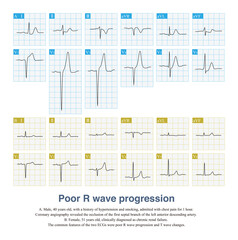 Poor R wave progression can be seen not only in acute coronary syndrome, but also in non ischemic heart disease, which is easily misdiagnosed as myocardial infarction.