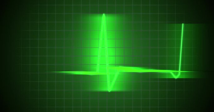 Heartbeat monitor animation. A smooth animation in high quality on a heart rate monitor in a hospital environment