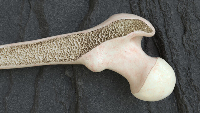 osteoporosis thigh bones from the inside- 3d rendering