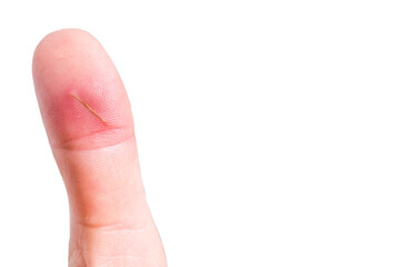 finger with splinter, infection, finger injury, copy space.