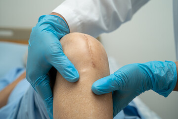 Asian senior or elderly old lady woman patient show her scars surgical total knee joint replacement...